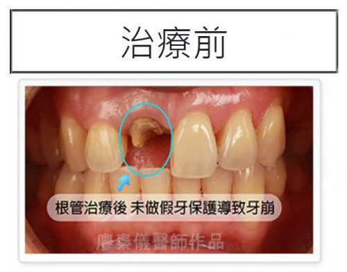 新竹牙裂