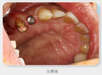 鈺恩 3D導航微創植牙鍾先生案例