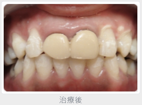 鈺恩 冷光美白2號張小姐案例